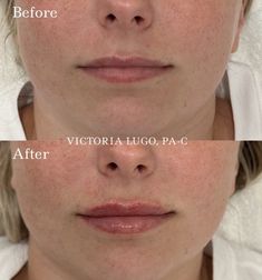 lip filler before and after Half Syringe Lip Filler Before And After, Lip Filler Before And After, Lip Injections, Beauty Stuff, Body Inspiration, All About Me!, Natural Makeup