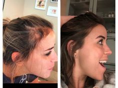 M Hairline, Uneven Hairline, Natural Hair Regrowth, Natural Face Care, Let It Grow, Grow System, Monat Hair, Perfect Skin Care Routine, Hair Control