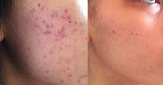 Back Acne Remedies, Lightening Serum, Acne Scar Removal, Cystic Acne, Scar Removal, How To Get Rid Of Acne, Acne Marks, Uneven Skin, Acne Prone Skin