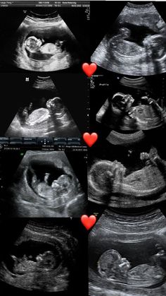 an x - ray shows different views of the chest and its surrounding area, with two red hearts on each side