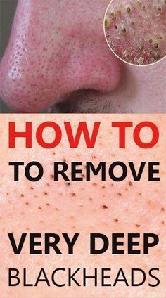 What Are Blackheads, Black Head Remover Mask, Blackheads On Nose, Skin Moles, Skinnytaste Recipes, Skincare Aesthetic, Get Rid Of Blackheads