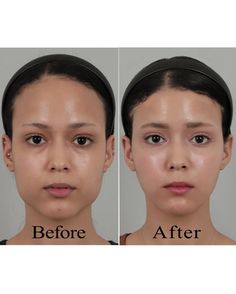 Jaw Reduction Surgery, Forehead Reduction, V Line Surgery, Plastic Surgery Fail, V Line Face, Korean Plastic Surgery, Face Surgery, Plastic Surgery Gone Wrong, Facial Massage Routine