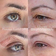 Home Treatments to Squeeze Out Blackheads #FacialCare #HealthySkin #BeautyTips #GlowingSkin #NaturalFaceMask Plasma Pen Fibroblast, Plasma Facial, Fibroblast Plasma, Best Dark Spot Corrector, Face Lift Surgery, Skin Aesthetics