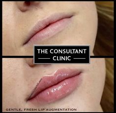 Lip Filler Inspiration Natural, Lips Injections Shapes, Botox And Fillers Before After, Lip Fillers Before And After 1ml, Lip Injections Juvederm, 0.5 Ml Lip Filler Before And After, Natural Lip Fillers, M Lips