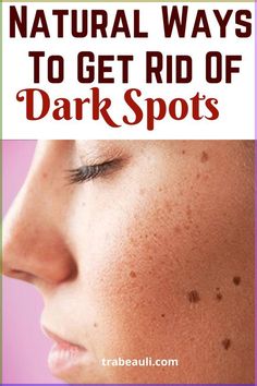 Overnight Remedies, Spots On Skin, Diy Anti Aging Cream, Dark Spots Remedies, Home Remedies For Skin, Erase Wrinkles, Dark Spots On Face, Overnight Beauty, Brown Spots On Face