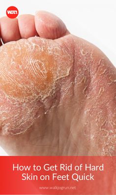 Peeling Skin On Feet How To Get Rid Of, Heel Callus Remover Diy, How To Get Rid Of Dry Skin On Feet Heels, How To Get Dry Skin Off Feet, Peeling Feet Remedy Diy, Dry Feet How To Get Rid Of, Dry Calloused Feet Remedy, How To Get Rid Of Dry Feet Skin, Feet Cracks Remedies