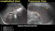 How To Measure The Spleen On Ultrasound | Splenic Length, Width, Thickness & Volume Measurements USG Ultrasound Machine, Length Measurement, How To Measure, Ultrasound