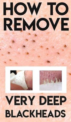 How To Remove Blackheads, Beauty Hacks That Actually Work, Black Head Remover Mask, Healthy Advice, Diy Remedies