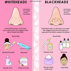 What To Do For Blackheads, Acne Guide, Skincare Niacinamide, Obličejové Masky, Skin Hacks, Types Of Facials, Skincare Advice, Nose Makeup