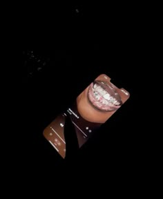 an open mouth with braces and teeth in the dark