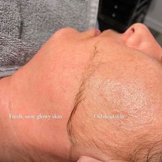 Dermaplaning Hair Regrowth: Will Hair Grow Out Thicker? Before And After Dermaplaning, Dermaplaning Before And After, Dermaplaning Benefits, Dermaplaning Facial, Home Dermaplaning, Benefits Of Dermaplaning, Dermaplane Facial Benefits, Medical Esthetician