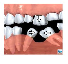 #ODC_fact Loss of one or two teeth in a segment of your mouth can lead to drifting of neighboring teeth, whereby the adjacent teeth lean over into the vacant space where the teeth have been lost. Similarly, loss of a tooth or teeth can lead to shifting of opposing teeth as they drift down into the open space (super-erupt). Dental Charting, Naturally Whiten Teeth, Dental Pictures, Dental Posts, Dental Posters, Dental Videos, Dental Fun, Loose Tooth