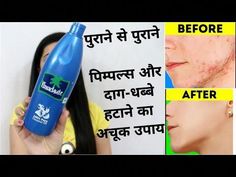 This Method helps to remove Acne and Pimples In a Short Span of time . Like and Subscribe 😀 Pimpal On Face, How To Remove Pimple Marks, Neem Face Pack For Acne, Pimple Remedies Overnight, Under The Skin Pimples, How To Treat Pimples, Pimple Scar Removal, Pimple Solution, Pimple Removal