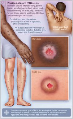 an info poster showing the effects of acne