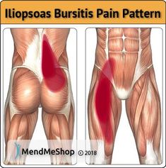 Iliopsoas Bursitis, Hip Pain Relief, Sciatica Exercises, Knee Pain Relief, Back Pain Exercises