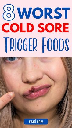 8 Best Strep Throat Self-Care Home Remedies Best Cold Sore Remedy Overnight, Heal Cold Sores Fast, Cold Sore Remedy Overnight, Fever Blister Remedy, Cold Sore Remedy, Cold Sore Stages, Cold Sore Prevention