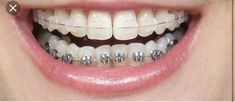 Natural Teeth Whitening Diy, Braces Cost, Invisible Braces, Health Aesthetic, Clear Braces, Teeth Whitening Remedies