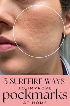 guide to get smooth clear skin Acne Pit Scars, Scar Remedies, Acne Scaring, Facial Scars, Forehead Acne, Acne Overnight, Acne Scar Removal, Face Acne