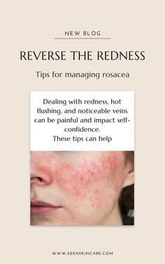 The rosacea struggle is real! Dealing with redness, hot flushing, and noticeable veins can be painful and impact self-confidence. We look at what causes rosacea and tips for getting redness under control. Reduce Face Redness, Redness On Face, Blood Pressure Medications, Nutrition Diet, Antioxidant Serum, Physical Sunscreen, Struggle Is Real, Skin Irritation, Beauty Ideas