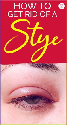 How To Get Rid Of A Stye: Styes are extremely common and usually occur at least once in one’s life. However, there is no need to be concerned because this eye condition is easily treatable. Let’s look at the symptoms, causes, and treatment options for an eye stye at home in this article. Keep reading! #eyestye #remedies #homeremedies Essential Oils For Eye Stye, What To Do For A Sty In Your Eye, Eye Inflammation Remedies, Eye Wash Solution Home Remedies, How To Get Rid Of Stye Eye, How To Get Rid Of A Stye On Your Eyelid, How To Get Rid Of Swollen Eyes, Remedies For Stye On Eyelid, How To Treat Pink Eye At Home