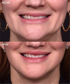 A smile is one of our most powerful features.  Aging can lead to a longer upper lip, a diminished smile and show of teeth, and an overall imbalance in the lower face. But what if there was a way to restore that natural, vibrant smile you once had? This is where deep plane lip lift surgery comes in—a transformative procedure designed to rejuvenate your appearance and bring balance to your facial features.

Deep plane lip lift surgery is a specialized procedure that shortens the upper lip, creating a more harmonious balance in the lower face. By lifting and reshaping the upper lip, this surgery can also brighten your smile, making it appear more youthful and lively. Unlike traditional lip lifts, the deep plane approach works on the deeper layers of tissue, ensuring longer-lasting and more na Facial Features, Your Smile, Most Powerful, What If