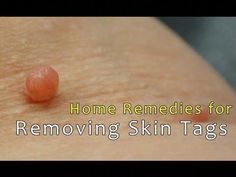 How To Remove Skin Tags Yourself, how to remove warts, how to remove warts on face, home treatment for warts, best way to remove warts, home Remedies for Rem... Skin Tags Apple Cider Vinegar, Witch Hazel For Skin, Remove Skin Tags, Mask For Oily Skin, Home Remedies For Skin, Get Rid Of Warts, Skin Tags, Skin Remedies, Skin Cleanser Products