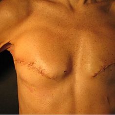 Here's What It's Really Like to Have a Double Mastectomy and Reconstruction