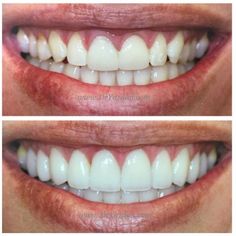 Cosmetic Dentistry Veneers, Cosmetic Dentistry Procedures, Fake Teeth, Teeth Implants, Dental Veneers