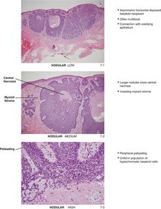 Basal Cell Carcinoma: Variants and Challenges | SpringerLink Colleges In Florida, Science Nerd, Google Scholar, Bacterial Infection, Fun Science, The United States, Surgery