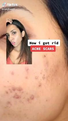 Haut Routine, Get Rid Of Acne, Rid Of Acne, Acne Skincare Routine, Clear Skin Tips, Moisturizer For Oily Skin, How To Get Rid Of Acne, Skin Care Routine Steps