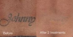 before and after photos of tattoo removal on the back of a man's stomach