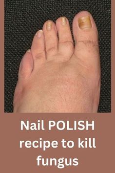 Fungal Infection Remedies, Toenail Health, Polish Recipe, Nail Remedies, Nail Fungus Remedy, Fungal Nail, Diy Nail Polish, Toenail Fungus, Fungal Infection