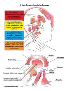 TRIGGER POINT THERAPY - TENSION TYPE HEADACHES (TTH) Punkty Spustowe, Tension Headache Relief, Home Remedies For Sinus, Forward Head Posture Exercises, Headache Types, Trigger Point Therapy, Trigger Point, Migraine Relief, Tension Headache