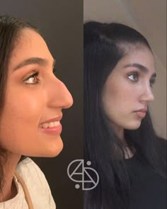 Nose Rhinoplasty Before After, Nose Before And After, Nose Job Results, Natural Nose Job Before After, Nose Surgery Before And After, Nose Job Natural, Nose Job Aesthetic, Reduction Rhinoplasty, Nose Jobs Before And After