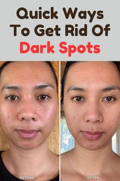 Video Icon, Natural Skin Care Ingredients, Brighter Skin, Lighten Dark Spots, Cosmetic Procedures, Skin Care Remedies, Bright Skin, Beauty Skin Care Routine