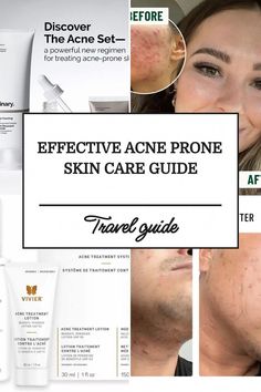 These are the best skin care kits for acne that will get rid of your cystic acne, hormonal acne, pimples, and whiteheads for acne-prone skin. Skin Care Routine For Acne, Skincare Routine Steps, Stubborn Acne, Effective Skin Care Routine, Acne Prone Skin Care, Skin Care Guide, Skincare Regimen