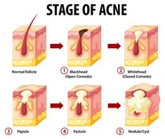 Scalp acne causes a lot of inconvenience in daily life. Find out how to get rid of scalp pimples and bumps fast and prevent them in the future. Pimples On Scalp, Painful Pimple, Scalp Acne, Back Acne Remedies, Acne Causes