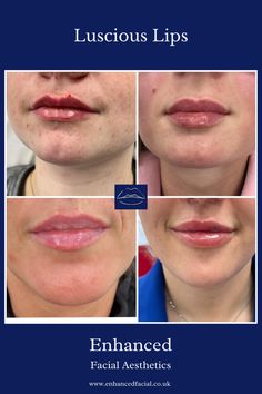 We love natural looking lips here, you won't find overfilled trout pouts here! Natural Lip Fillers