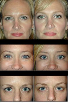 Botox For Eyebrow Lift, Eyebrow Botox Lift, Eyelid Lift Before After, Eyebrow Lift Botox Before And After