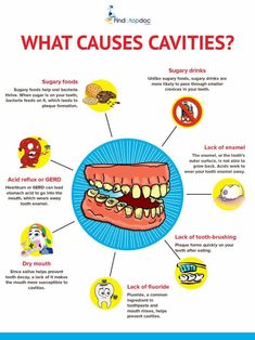 What Causes Cavities? Dentist Crafts, Teeth Surgery, Holistic Dentistry, Dental Implants Cost, Sedation Dentistry