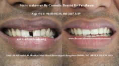 Dr Trivikram(Dr Vikram), an expert cosmetic dentist in Bangalore offers smile makeover. Visit: http://www.allsmilesdc.org/ Interesting Art, How To Make An, Tree Branches, Art