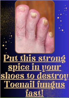 This formula is unlike anything you've ever tried or experienced in your life before. You will be able to support a fungus-free life, without worrying about itching or foul smell. All that while enjoying flawless nails and skin. Toenail Ideas, Fungal Infection Remedies, Fingernail Fungus, Types Of Fungi, Nail Fungus Remedy, Ingrown Toe Nail, Toenail Fungus, Fungal Infection, Nail Fungus