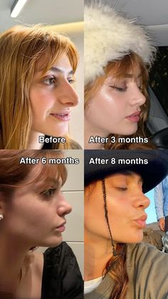 Rhinoplasty Recovery Tips, Nose Job Before And After Rhinoplasty, Nosejob Rhinoplasty Before After, Nose Job Before And After, Revision Rhinoplasty, Kpop Plastic Surgery, Jaw Reduction Surgery, Plastic Surgery Fail, Rhinoplasty Nose Jobs