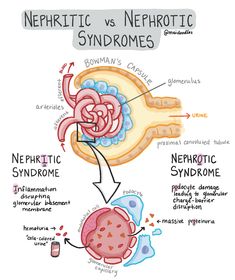 nephritic and nephrotic syndrome in the human body, diagram