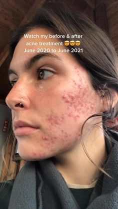 skin2 Lnk.Bio · link in bio - Profile and social media links for skin2 Before And After Acne, Skin Tags, Types Of Acne, Acne Free, How To Get Rid Of Acne, Remove Acne