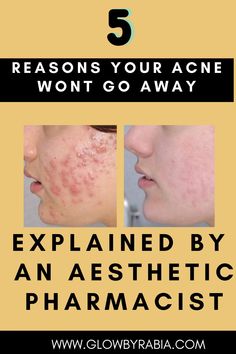 why your acne will not go away explained by an aesthetic pharmacist, there are many factors to acne and acne treatments, we will discuss steps you can take to to clear acne and get clear skin. Acne| Acne treatments| acne types | Acne reasons| Acne explained| health| Skin care| acne remedies| Acne scar remedies| acne medication| acne advice|Acne medication| skincare| skin pharmacist Best Acne Cleanser, Acne Medication