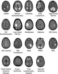 the different areas of the brain are labeled in black and white, including mris