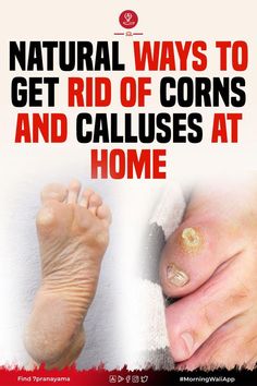 To prevent corns and calluses from developing or recurring, it Dry Skin Home Remedies, Get Rid Of Corns, Corn Removal, Face Pores, Nail Fungus Remedy, Callus Removal, Hydrogen Peroxide