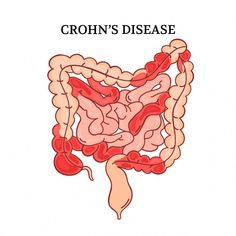 CROHN DISEASE VIDEO Intestinal Medicine Scheme Anatomy Human Hand Drawn General Diagram With Explanatory Text For Medical Education Moving Banner For Teaching Intestines Anatomy, Medicine Anatomy, Anatomy Illustration, Health Signs, Women Health Care, Hand Drawn Vector Illustrations, Human Hand, Medical Education, Nursing Students