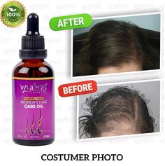 "✨ Wyess Hair Growth Oil ✨ Transform your hair with our powerful formula! 🌿 Enriched with 33 vegetable oils, this hair growth oil is designed to thicken, strengthen, and restore your hair, providing fast-acting results for all hair types. Why Choose Wyess Hair Growth Oil? 🌱 Natural Ingredients: Infused with the best natural oils, including rosemary, black castor oil, and onion hair oil. 💧 Deep Moisturization: Provides intense hydration, preventing dryness and revitalizing your scalp. 🚀 Fast-Acting: Promotes quick hair growth and healthy hair appearance with regular use. 🛡️ Hair Strengthening: Helps control hair loss and strengthens hair strands, making them more resilient. How to Use: Apply to clean, dry hair. Massage into the scalp using your fingertips. Leave on for at least 30 minu Onion Hair Oil, Onion Hair, Quick Hair Growth, Natural Hair Growth Oil, Onion For Hair, Quick Hair, Hair Strands, Hair Massage, Black Castor Oil